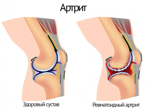 Лечение суставов: боли в коленях